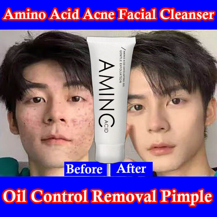 Facial Foam cleanser Deep Cleanser Acne Marker remover Acne Removal