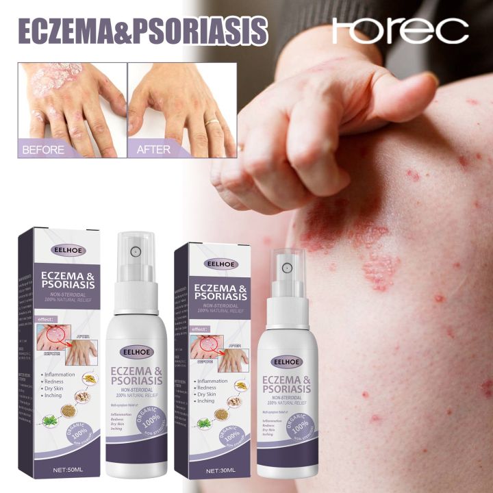 horec-30m-50ml-eelhoe-tinea-pedis-สเปรย์-ยารักษาโรคกลาก-หนังศีรษะ-โรคสะเก็ดเงิน-มือ-เท้า-กลิ่นเกลื้อน-ยับยั้งเชื้อรา-ป้องกันอาการคัน