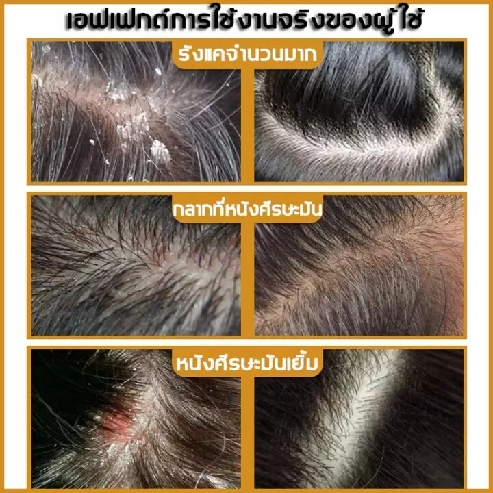 แชมพูขจัดรังแค-แชมพูสระผม-ยาสระผมเชื้อรา-แชมพูยาขจัดรังแค-มีรังแค-ป้องกันรังแค-ขจัดไร-ควบคุมความมันและอาการคัน-ครีมสระผม-ครีมขจัดรังแค-ยาสระผม-shampoo-แชมพูแก้ผมร่วง-500ml