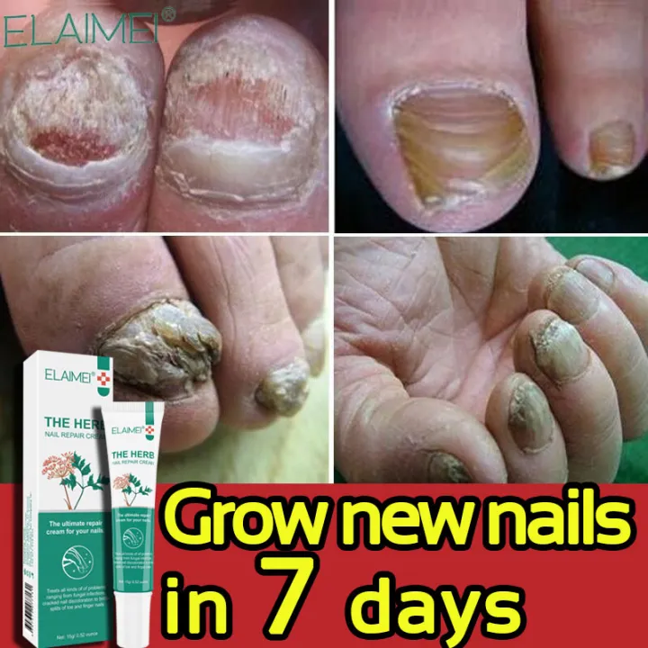 Herbal Anti-bacterial Nail Repair Cream Nail Fungus Repair Treatment ...