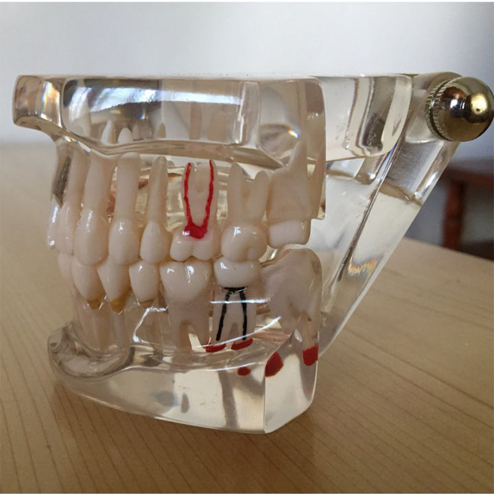 ฟันศึกษาฟันใสผู้ใหญ่ทางพยาธิวิทยาฟันรุ่นเหมาะสำหรับผู้ใหญ่การเรียนการสอน