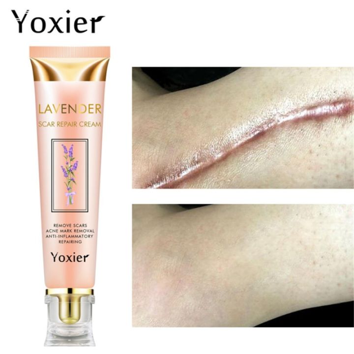 yoxier-ครีมลบรอยแผลเป็นครีมสิวซ่อมแซมรอยแผลเป็นผิวแก้ผิวคล้ำแก้อาการแพ้ครีมผิวขาว1ชิ้น