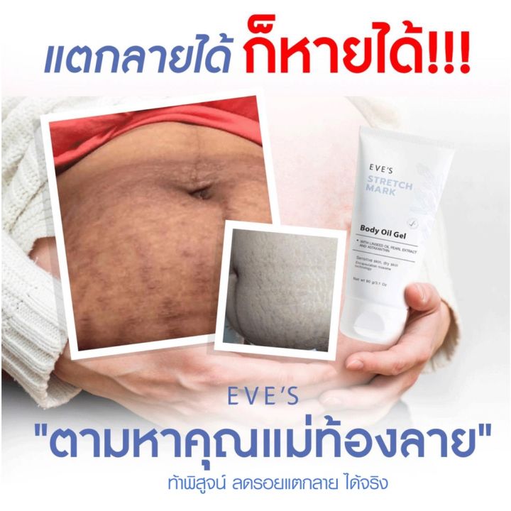 eves-เซตคู่ลดรอยแตกลาย-ครีมบูสเตอร์-ออยล์เจลอีฟส์-ป้องกันรอยแตกลาย-ลดรอยแผลเป็นจุดด่างดำ-ผิวกระจ่างใส-ชุ่มชื้นเนียนนุ่ม