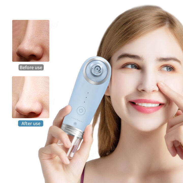 Blackhead Removal Small Bubble Cleaner Vacuum Suction Water Cycle Acne