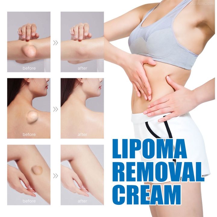 lipoma-removal-cream-ครีมก้อนเนื้องอกไขมัน-สมุนไพรกำจัด-ก้อนเนื้อใต้ผิวหนัง-ก้อนซีสต์-30g-ก้อนไขมันแข็ง-เนื้องอกไขมัน