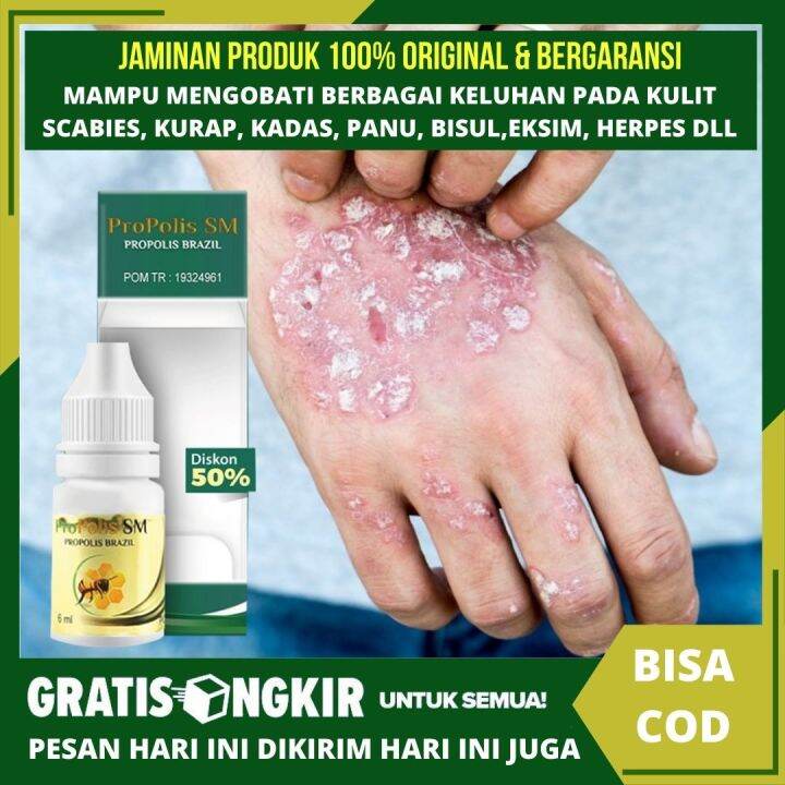 Obat Gatal2 Untuk Kulit - Obat Scabies Untuk Manusia - Salep Penyakit ...