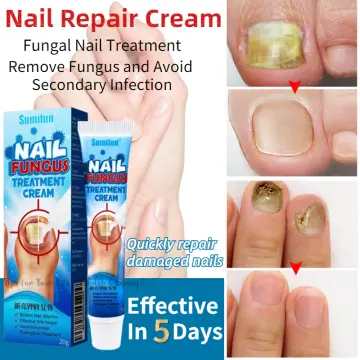 Fingernail Fungus from Acrylic Nails: Causes, Treatment, More