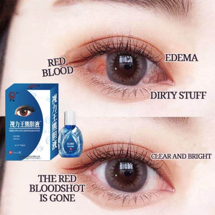 Eye Drops Relieve Visual Fatigue Clear Vision Eyedrops Treat Bloodshot