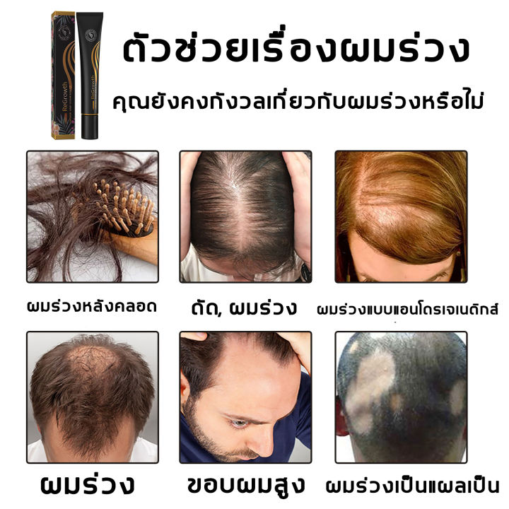 eelhoe-เซรั่มบำรุงผม-เซรั่มปลูกผม-บอกลาหัวล้าน-ป้องกันผมร่วง-เร่งผมยาว-น้ำยาปลูกผม-น้ำยาเร่งผมยาว-ปลูกผม-เซรั่มปลูกผมดก-น้ำยาเร่งผมยาว-เซรั่มบำรุงผม-เพิ่มเส้นผม-ลดผมร่วง-หยุดผมร่วง-รักษาผม-วิตามินบำรุ