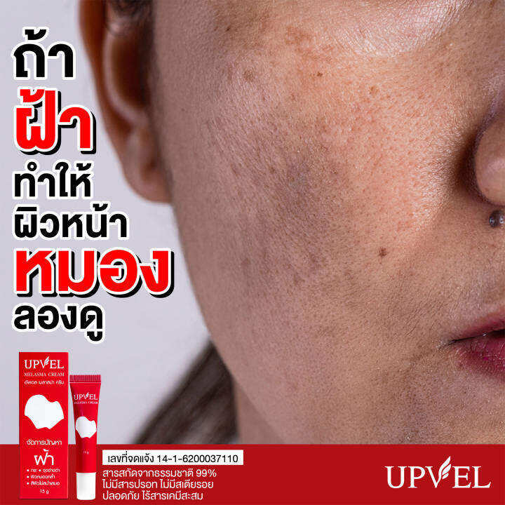 upvel-melasma-cream-อัพเวล-เมลาสม่า-ครีม-15-กรัม