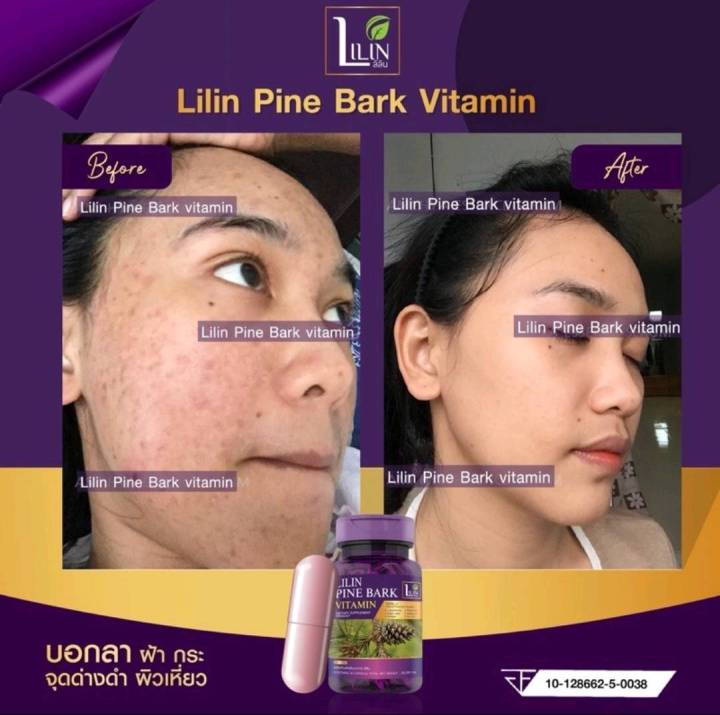 5-ขวด-สุดคุ้ม-lilin-pine-bark-วิตามินสลายฝ้า-วิตามินแก้ฝ้า-lilin-pine-bark-vitamin-วิตามินlilin-กระ-จุดด่างดำ-ผิวเหี่ยว-ลดริ้วรอย