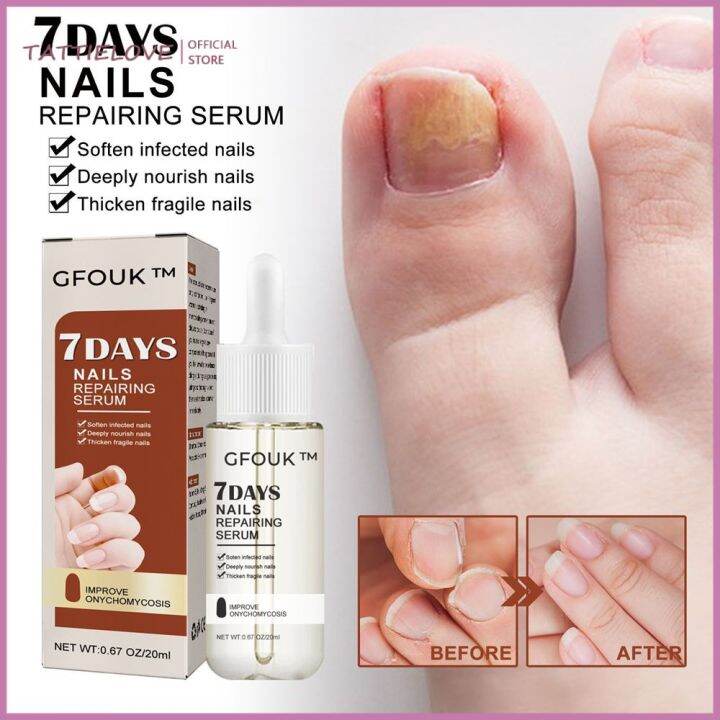 Thickening Toenails