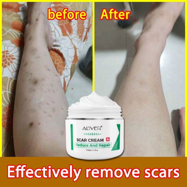 Aliver Scar Remover Cream For New Old Scars On Legs Face Body Scar Remove Surgical Stretch Marks 7871