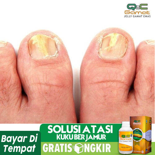 Obat Kuku Berjamur Dan Rusak, Obat Kuku Kaki Rusak, Kuku Tangan Rusak