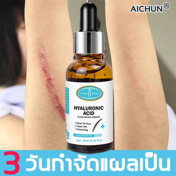 Aichun ครีมลดรอยแผลเป็น 30ml ครีมทาแผลเป็น สำหรับแผลไฟไหม้ น้ำร้อนลวก รอยแผลเป็น แผลเป็น สิว รอย