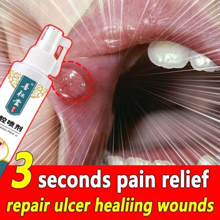 Hot zylp05 Canker sore spray 50ml mouth ulcer treatment Canker mouth