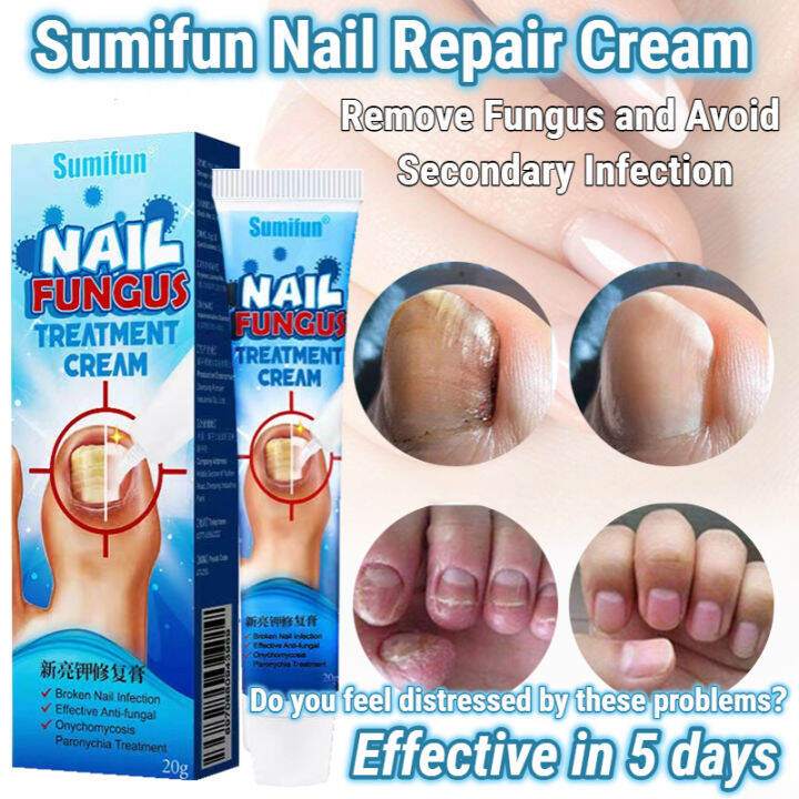 Nail Fungus Repair Treatment Cream Nail Care Essence Care Cream Anti
