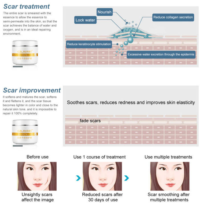 กำจัดสิวบนใบหน้าลบรอยแตกลายแผลเป็นเครื่องรักษาสิวทำให้ผิวขาวครีมทาแผลเป็นครีมบำรุงผิวความชุ่มชื้น