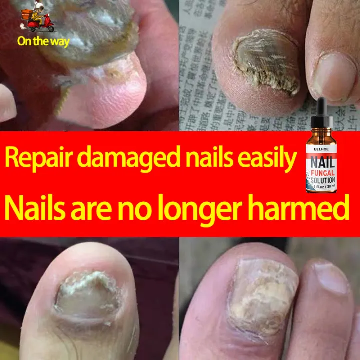 nail-fungus-treatment-nail-care-nail-treatment-fungal-nail-repair