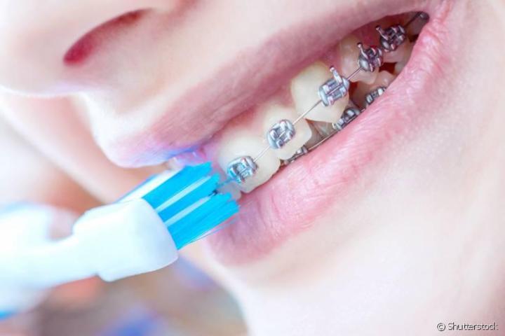แปรงสีฟันสำหรับผู้จัดฟัน-นวัตกรรมจากญี่ปุ่นx2ด้าม