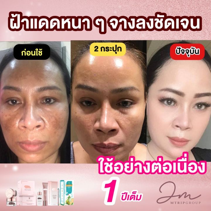 เซ็ตยอดนิยม-ครีมจัดการฝ้าjolasma-1-มาคู่กันแดด-1-กู้ฝ้าเรื้อรัง-เป็นมานาน-10-ปี-20-ปี-แพ้สารหนักมาก-ทาครีมเท่าไรก็ไม่จาง-ต้องลองคู่นี