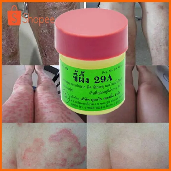 14G Anti Fungal Treatment Ringworm Scabies Athletes Foot Tinea Ointment ...