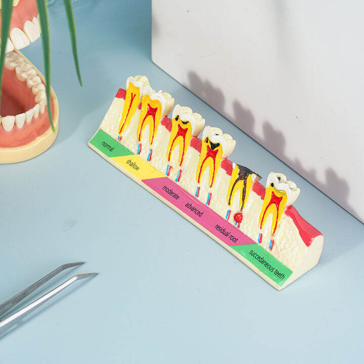 Dental Analysis Model Caries Classify Teeth Model Lazada PH