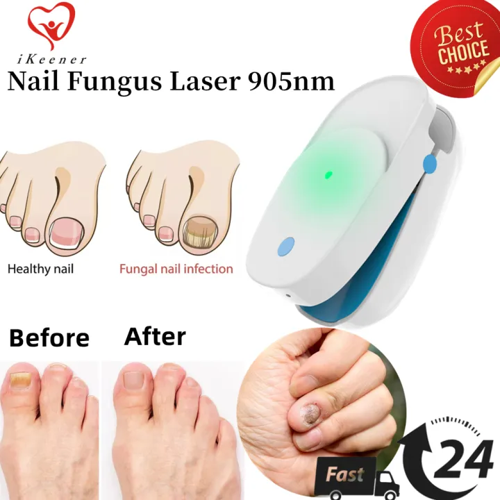 iKeener Nail Light Therapy Onychomycosis Laser Treatment Nail Fungus ...