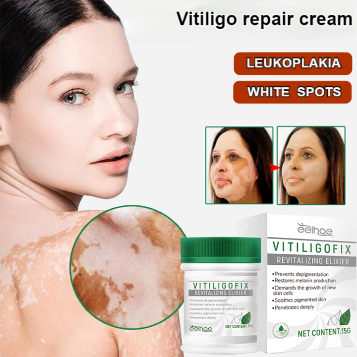 ECOOL Vitiligo repair cream skin tone uniform skin tone care cream