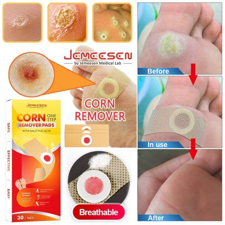 30 PCS Foot Warts remover FOOT Corns Remover Patch To remove calluses ...