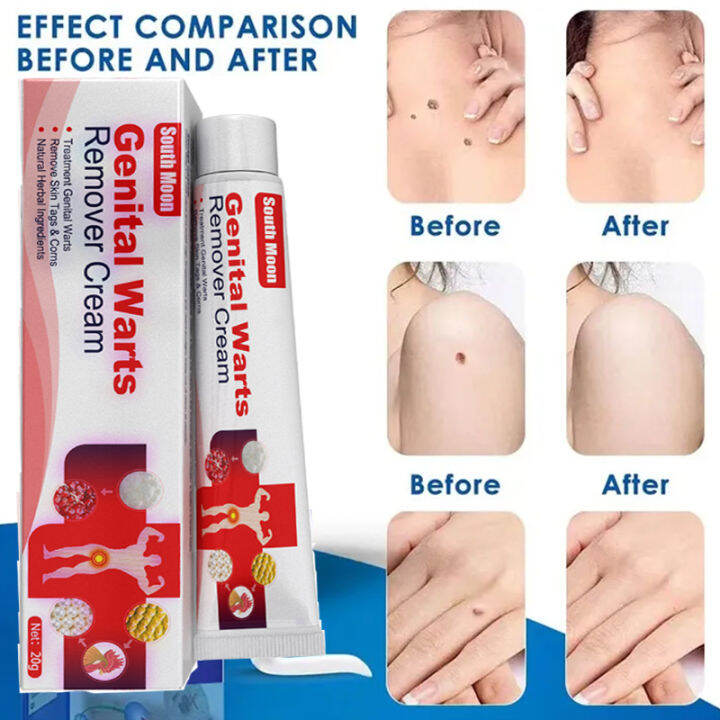 Wart Removal Ointment Warts Skin Tag Cream Warts Cream 20g Warts Remover Original Cream Removal 6627