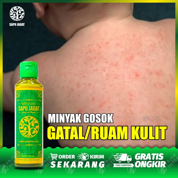 Obat Gatal2 Kulit Anak Obat Alergi Badan Obat Alergi Ruam Di Kulit Gatal Gatal Biduran Kaligata