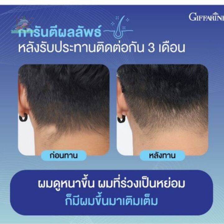 กิฟฟารีน-ไบโอติน-เอช-พลัส-ผมร่วง-ผมบาง-หัวล้าน-บำรุงเส้นผม-ลดการขาดหลุดร่วงของเส้นผม-ผมแลดูแข็งแรง-เงางาม-giffarine-biotin-h-plus