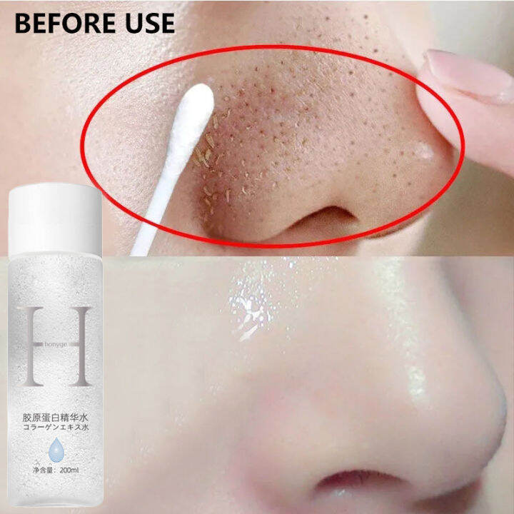 Collagen Facial Toner Anti Acne Blackheads Whiteheads Facial Toner Anti