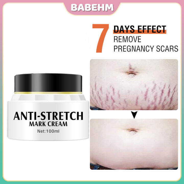 Remove Stretch Marks And Scars Of Pregnancy Skin Repair For Powerful ...