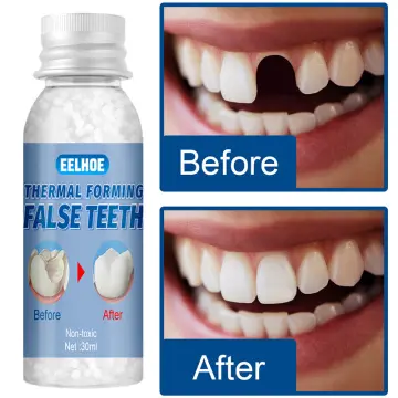 Thermal Forming False Teeth Reusable Super Strong Moldable Teeth Repair Kit  30g Tooth Gap Filler Tooth Repair Kit For Missing - AliExpress