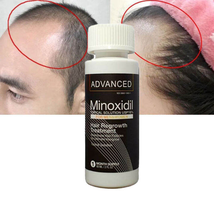 Minoxidil 10% Hair Growth Powerful Hair Grower Hair Care 100% Pure ...