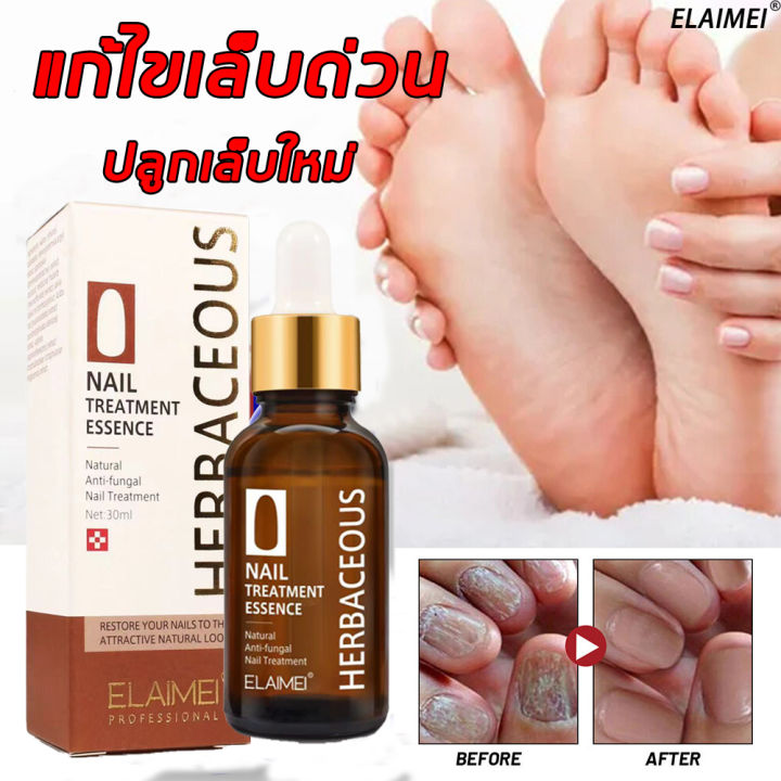 เซรั่มซ่อมแซมเล็บ-elaimei-เล็บเชื้อรา-30ml-ยาทาเชื้อราที่เล็บ-บำรุงเล็บมือ-เชื้อราที่เล็บ-ยาเชื้อราเล็บ-น้ำยาขัดเล็บ-บำรุงหน้าเล็บ-ยากันเชื่อราเล็บ-ชุดแต่งเล็บขบ-บำรุงเล็บเสีย-อุปกรณ์ทำเล็บ-ครีมบำรุงเ