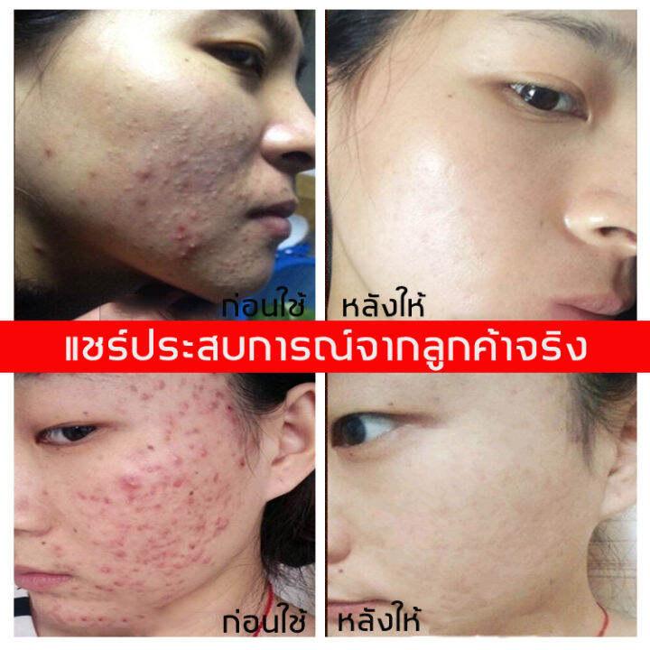 breylee-เซรั่มลดสิว17ml-เซรั่มรักษาสิว-สามารถลดสิว-บล็อกสิว-สิวไม่อักเสบ-สิวหัวขาว-สิวหัวดำ-กำจัดสิว-สิวอุดตัน-สิวผด-ไม่มีหัว-หลุมสิว-ซ่อน-ลดรอยแผลเป็นจากสิว-รอยดำจากสิว-ครีมแต้มสิว-เจลรักษาสิว-ครีมกำ