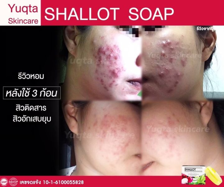 shallot-soap-สบู่หอมแดง-3-ก้อน-ส่งฟรี-หน้ากระจ่างงใส-ผิวนุ่ม-สิว-ฝ้า-กระ-จุดด่างดำ