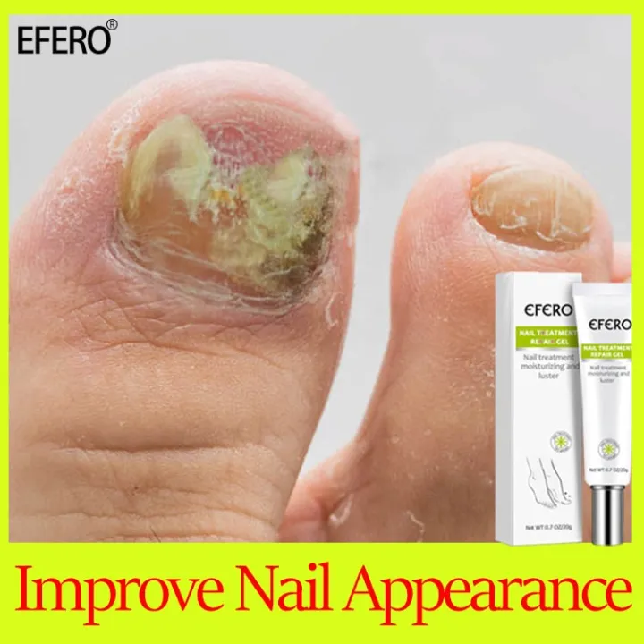 EFERO Nail care oil/cream 20g Help healthy growth nails,Nail repair the liquid,Nail treatment