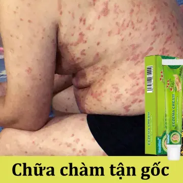 Có những loại kem chữa trị chứa eczema có chất lượng tốt và giá cả hợp lý không?