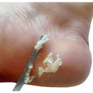1PC Foot Scraper Toe Nail Foot Dead Skin Remover Feet Pedicure Knife  Stainless Steel Heel Scraper File Manicure Accessories
