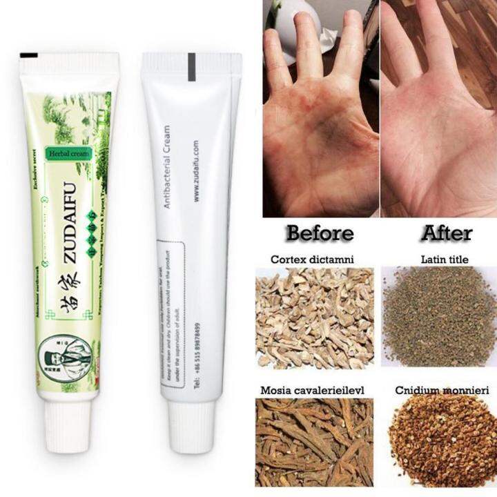 Zudaifu Cream Original Miracle Cream Ointment for Allergy Itchy Skin Eczema Psoriasis Treatment