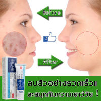 【มีสินค้าพร้อมจัดส่ง】Dr.LeDun ครีมลดสิว 20g รอยแดง รอยดำจากสิว ดูดซับอย่างรวดเร็ว ดูดซับความมันส่วนเกิน (ครีมแก้ฝ้า สิวหายถาวร ครีมแต้มสิว เจลรักษาสิว เจลแต้มสิว ครีมกำจัดสิว ครีมบำรุงหน้า ครีมหน้าขาวใส ครีมรักษาสิว) Acne cream