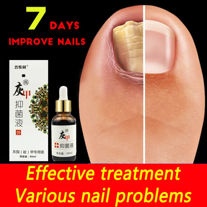 Beat onychomycosis Onychomycosis antibacterial liquid Nail care ...