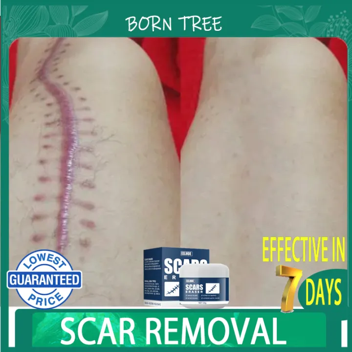 scar remover for old scar on leg fix scar removal original revi cream