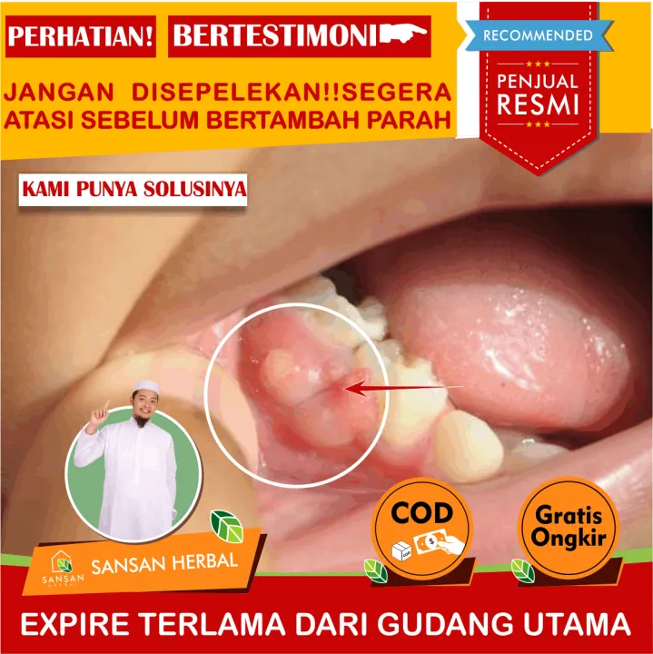 sakit gigi gusi bengkak berdarah 14