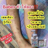 ขายดี!! BABES บาเบส เซ็ตแก้ขาลาย 3 ชิ้น สำหรับเด็ก (บาล์มแก้คัน, บอดี้เจล, สบู่) ลดอาการคัน แพ้ยุง ลดรอยดำ