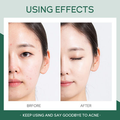 06-ชุดดูแลสิว-4-ชิ้น-สารสกัดจากใบชา-tea-tree-acne-โทนเนอร์-เจลแต้มสิว-เซรั่มบำรุงผิว-เซรั่มของสิว